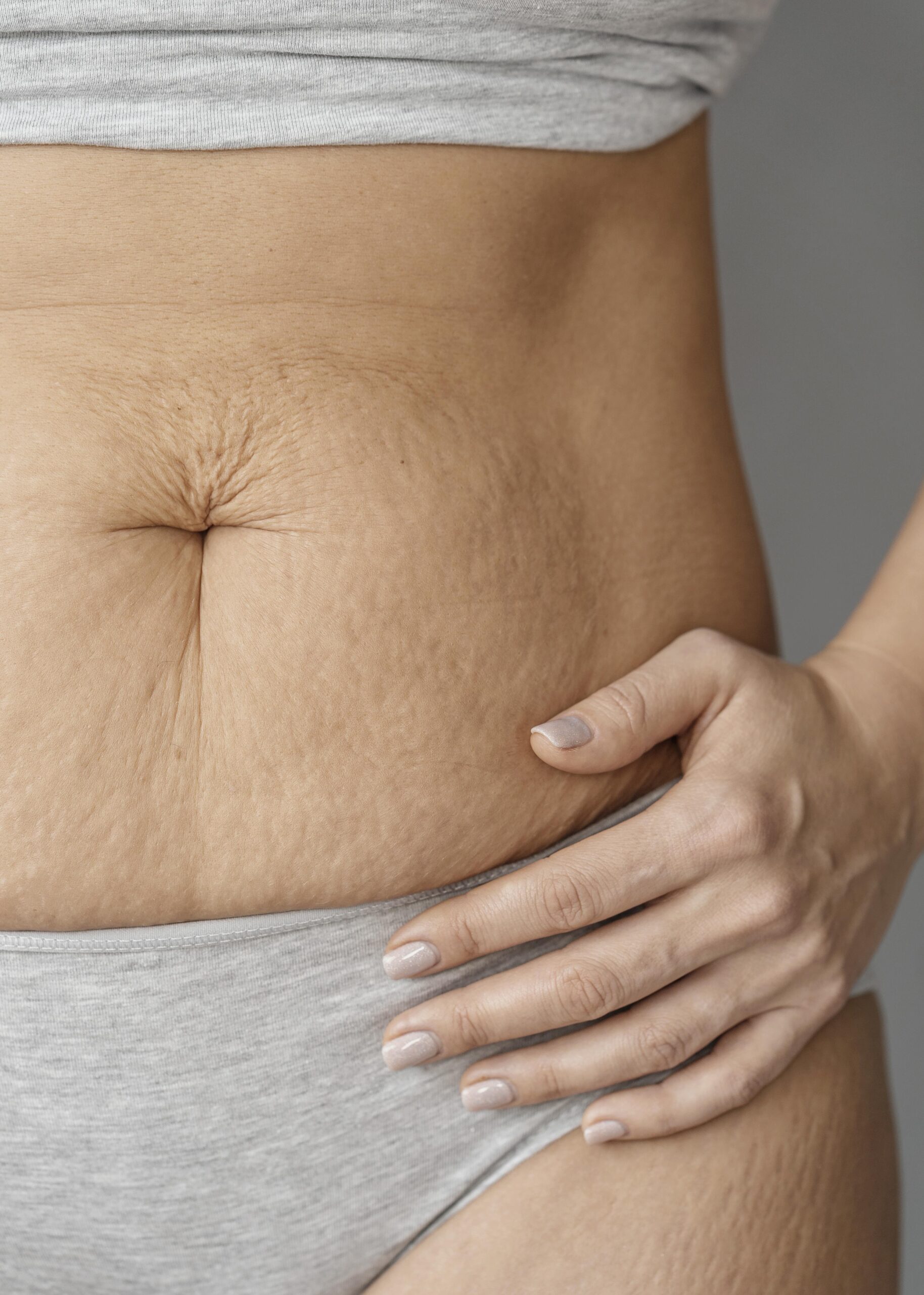 Close-up of stretch marks on skin, Armoraa skin clinic Chennai