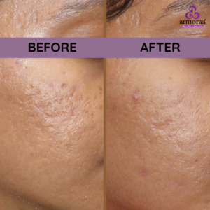 MNRF Treatment in Chennai - RF Microneedling Doctor