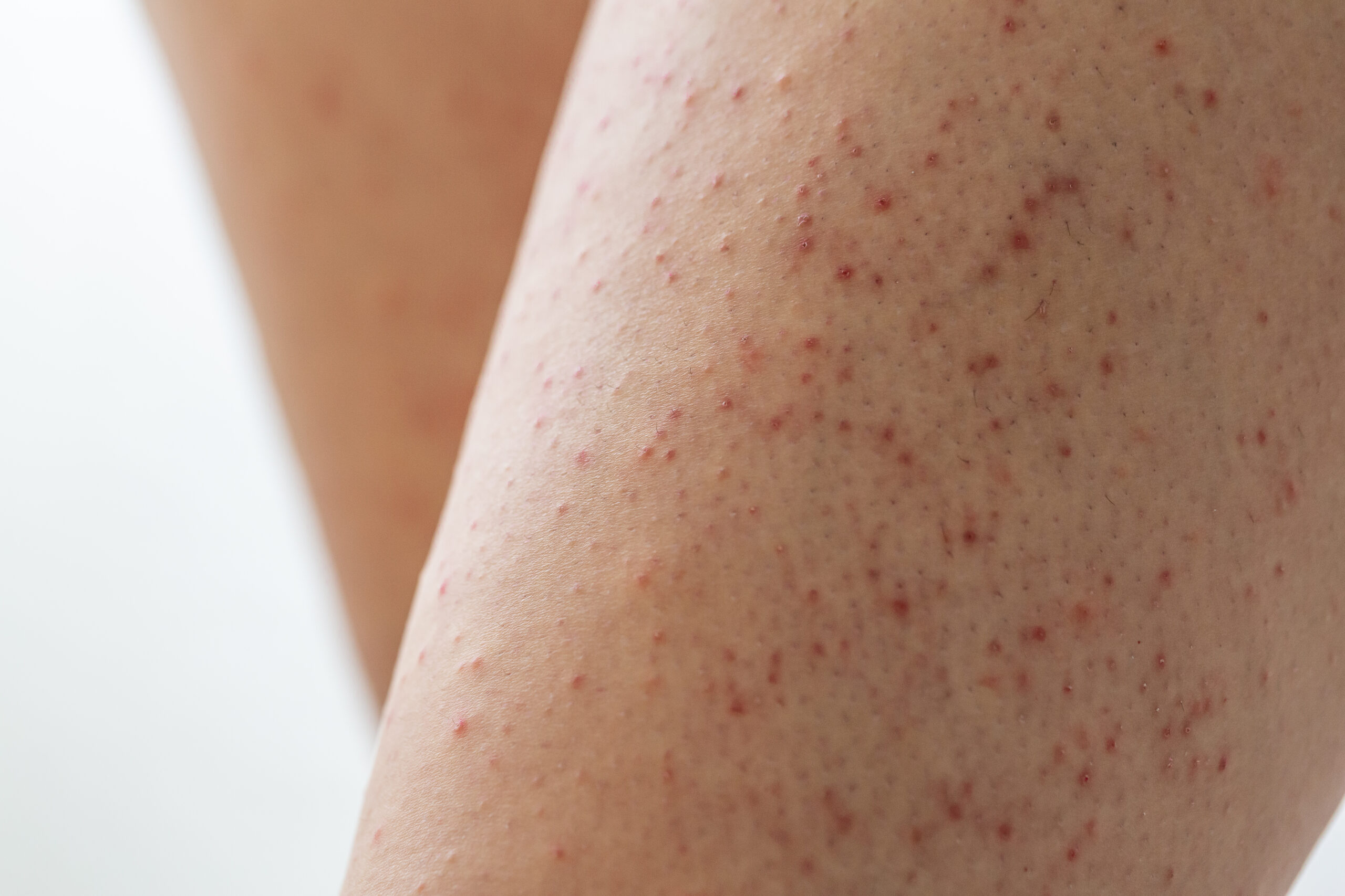 Itchy Red Bumps On Legs After Swimming In Lake