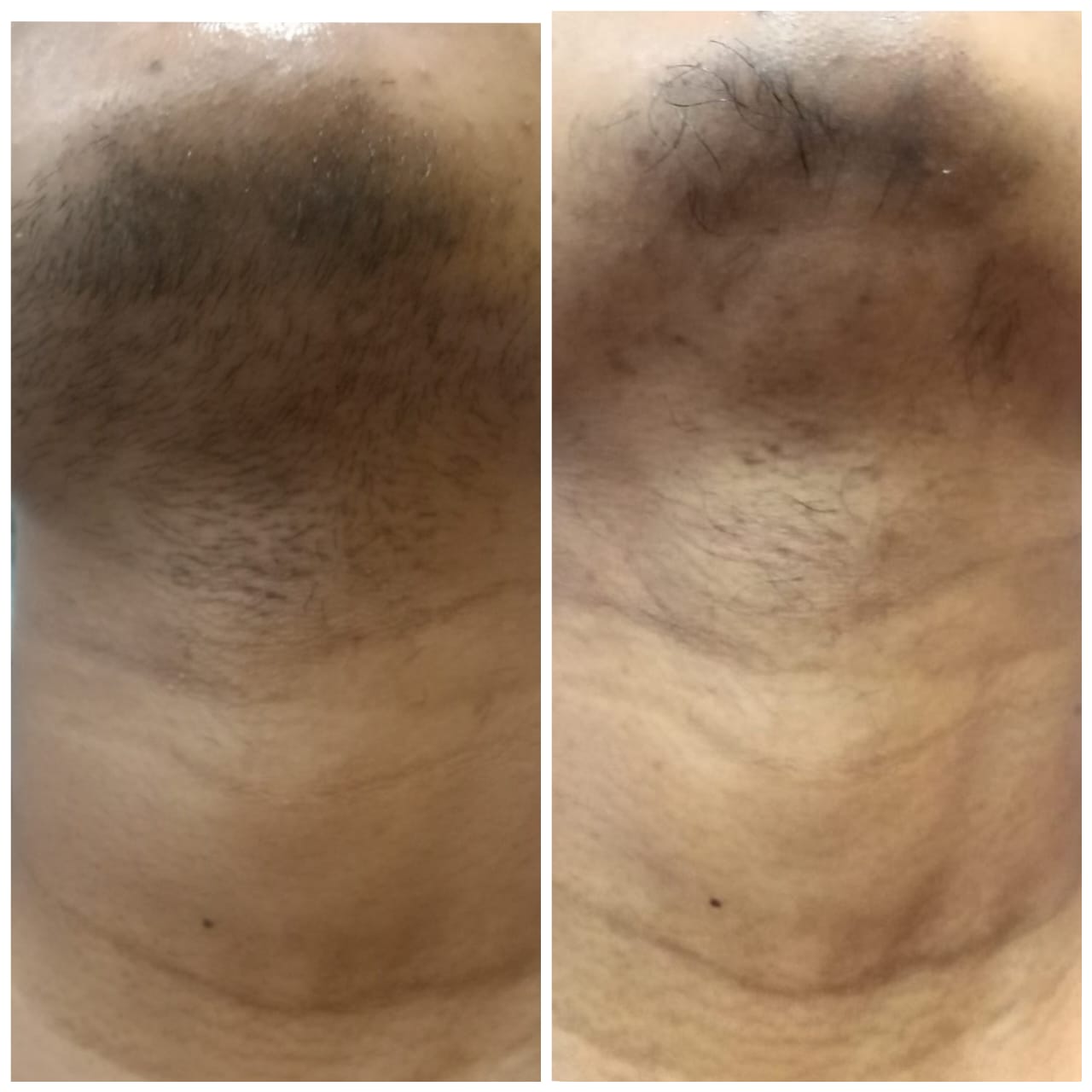 Before and after laser hair reduction results at Armoraa skin clinic, Chennai