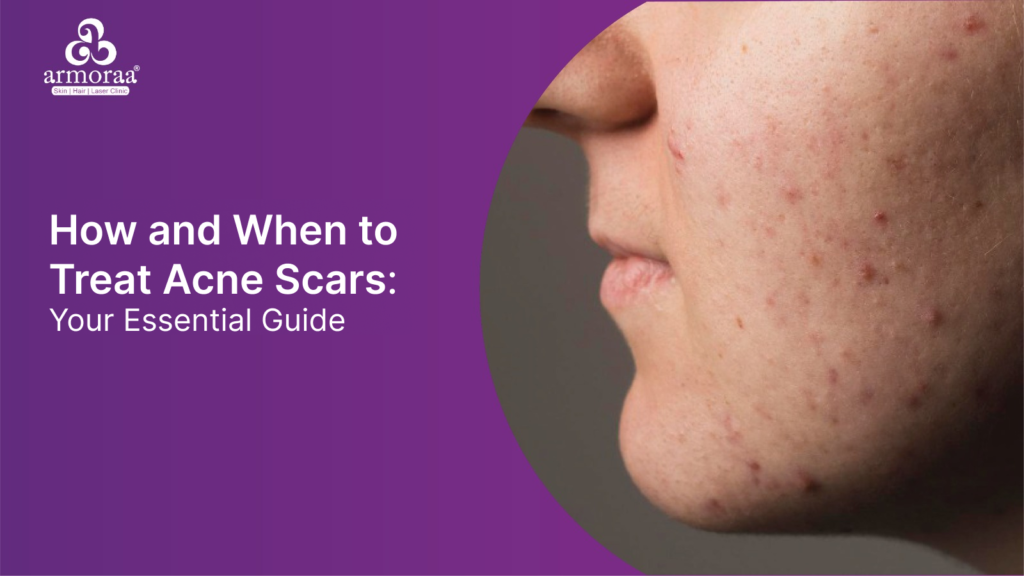 How and When to Treat Acne Scars: Your Essential Guide