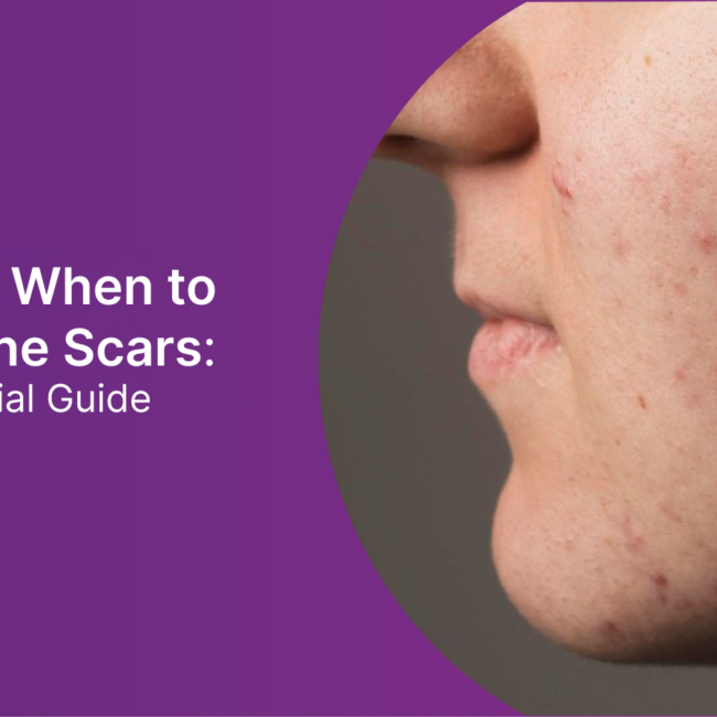 How and When to Treat Acne Scars: Your Essential Guide