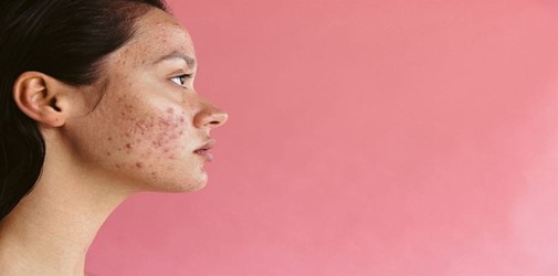 acne scars