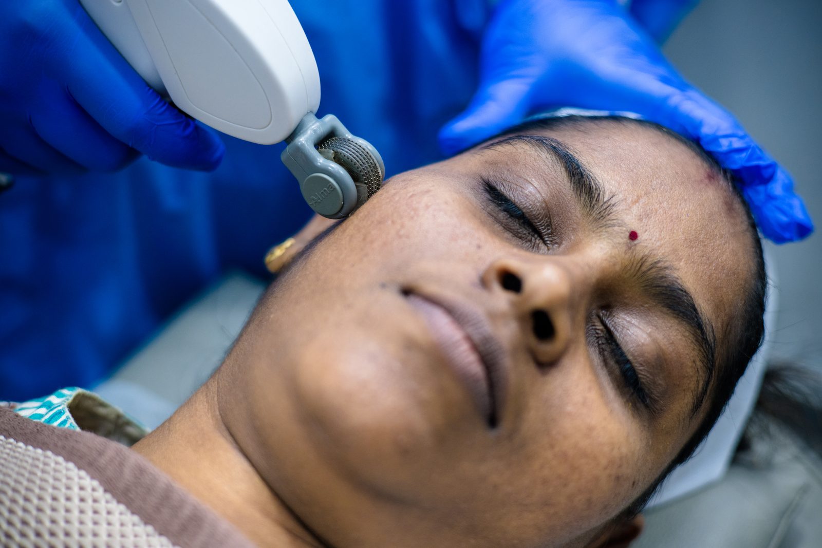 Radiofrequency microneedling treatment setup for acne scars at Armoraa skin clinic, Chennai