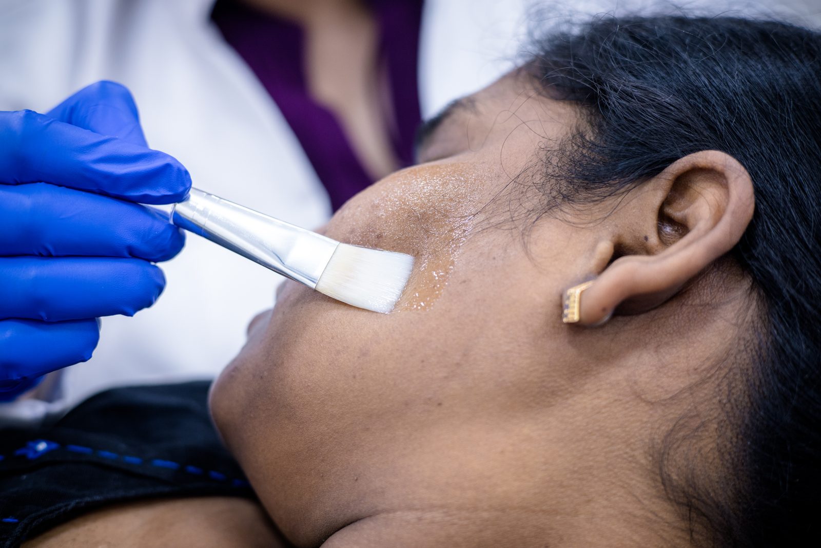 Chemical peel treatment setup for acne at Armoraa skin clinic, Chennai