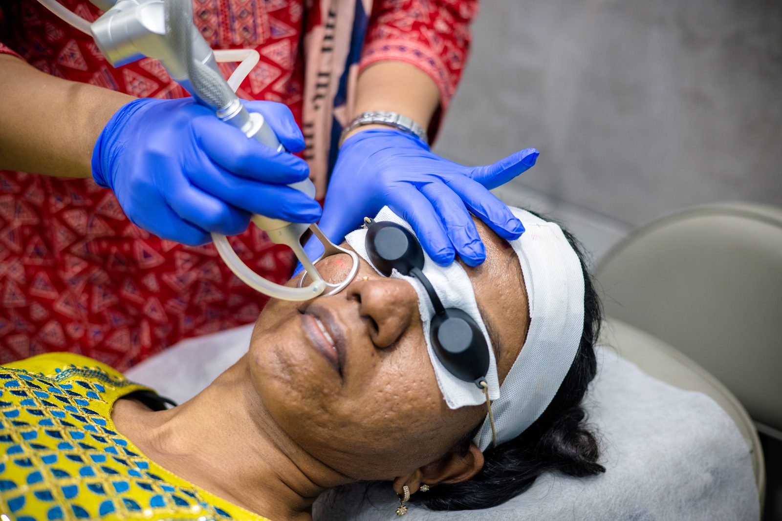 Laser scar treatment procedure at Armoraa skin clinic, Chennai