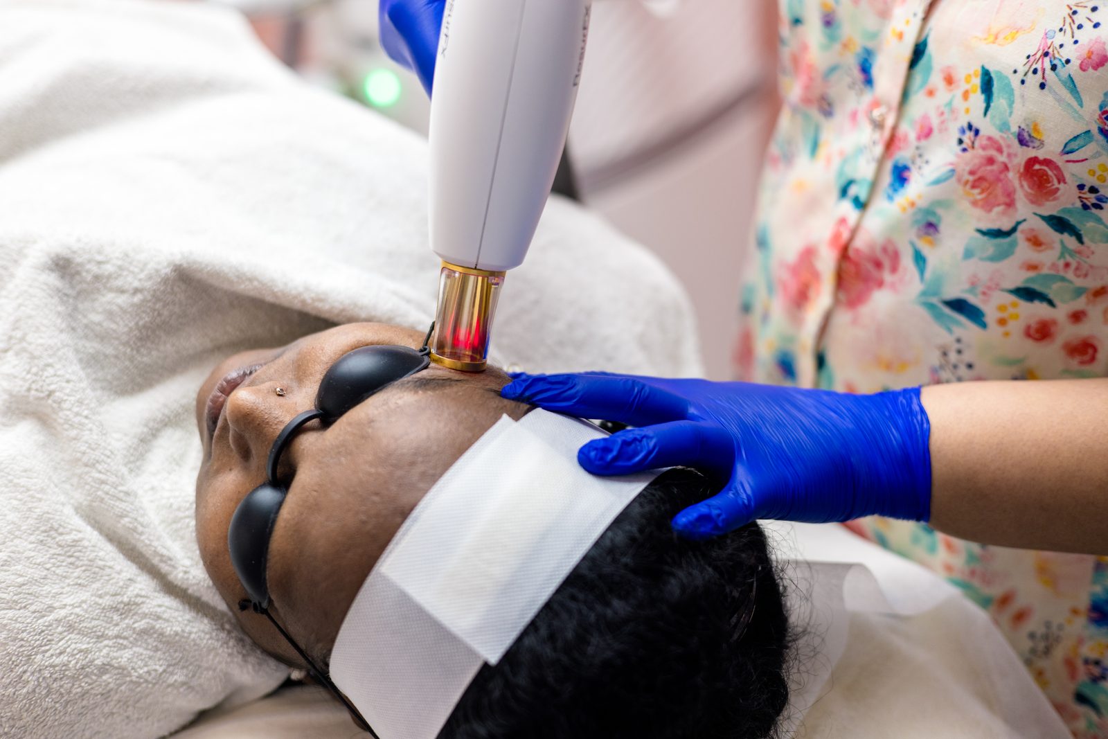 Erbium laser treatment setup for acne scars at Armoraa skin clinic, Chennai