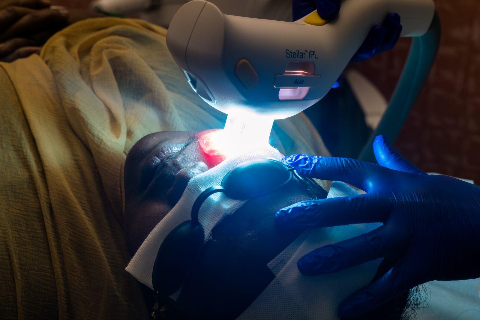 IPL (Intense Pulsed Light) treatment setup for acne at Armoraa skin clinic, Chennai