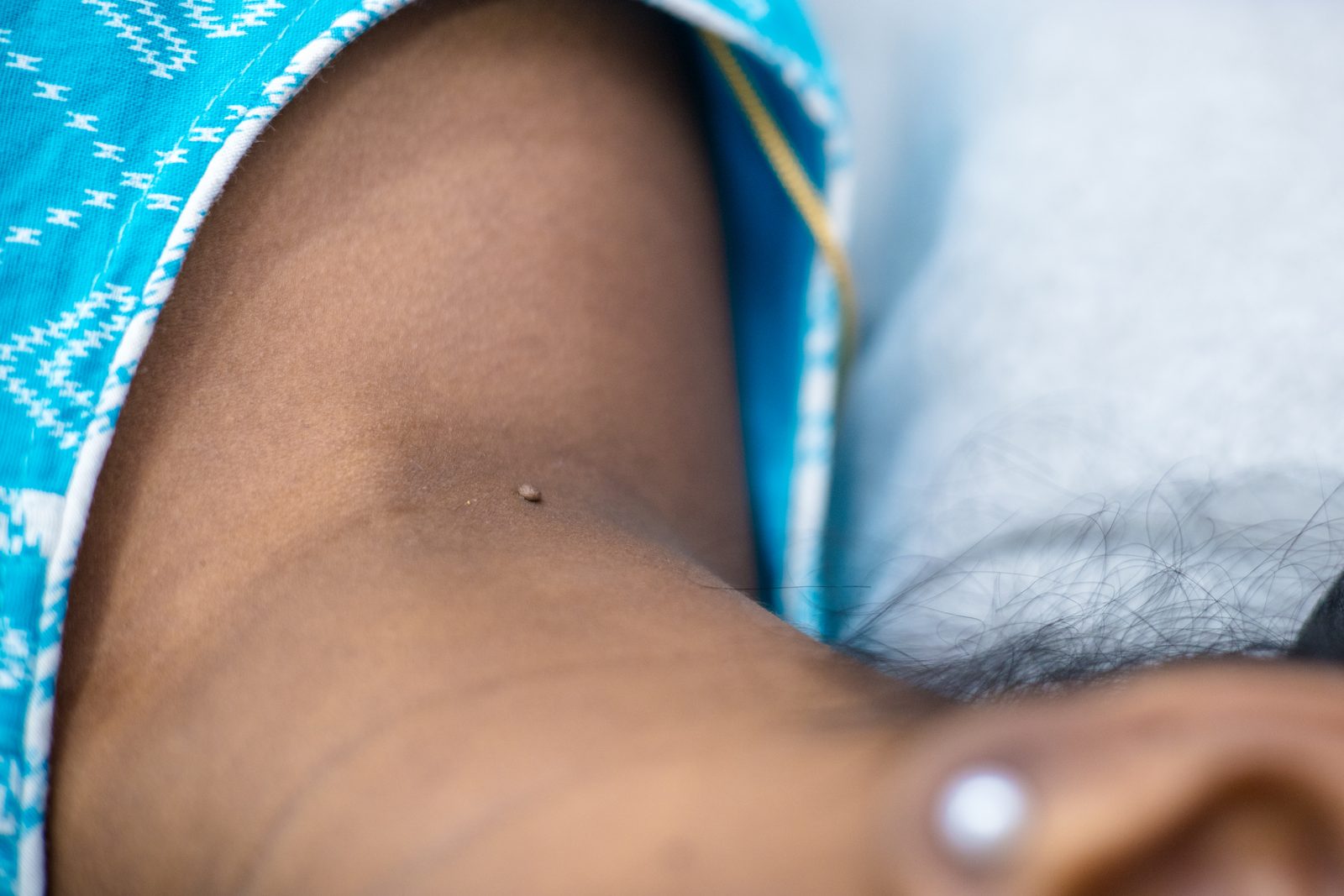 Benign skin lesion removal procedure setup at Armoraa skin clinic, Chennai