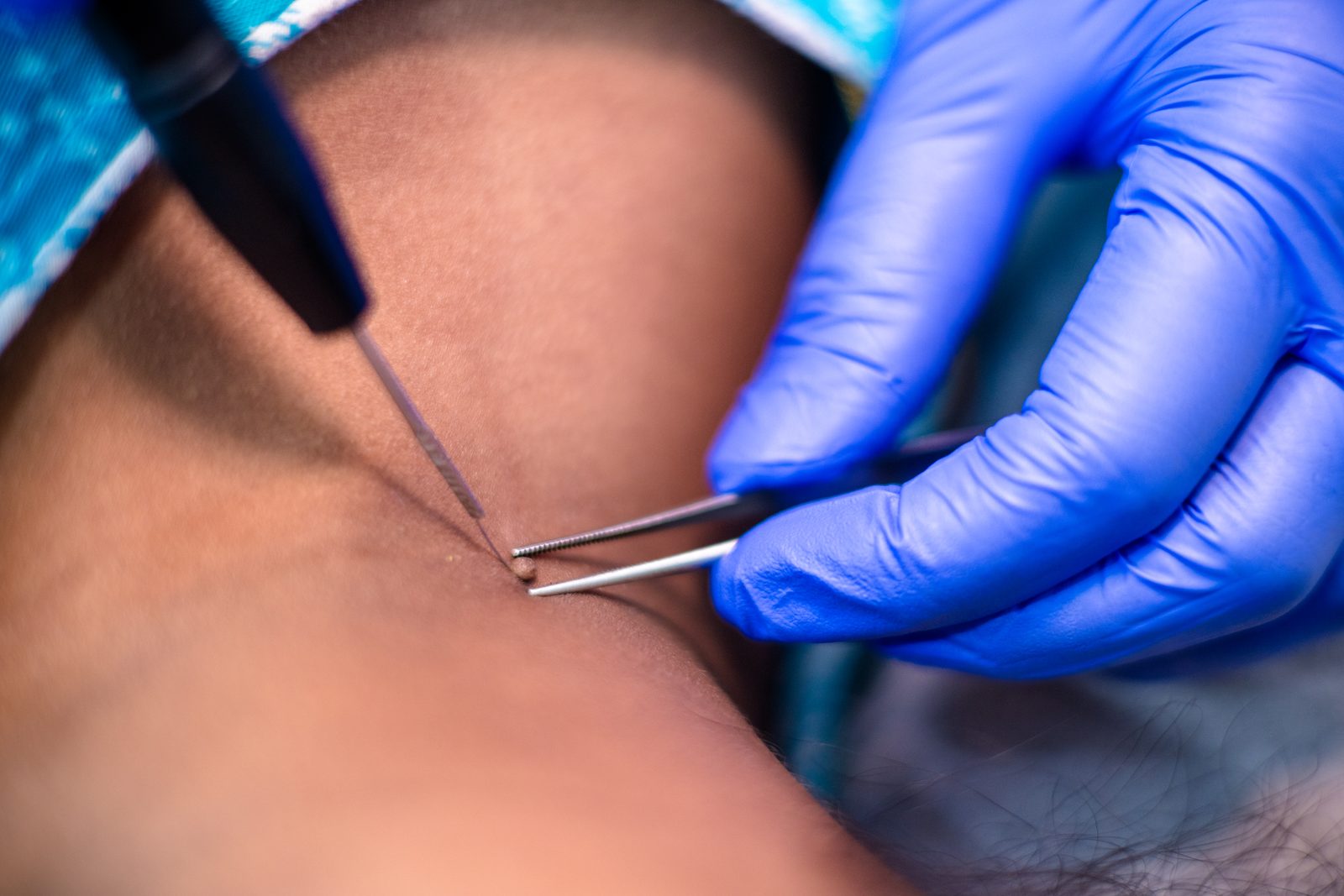 Benign skin lesion removal instrument setup at Armoraa skin clinic, Chennai