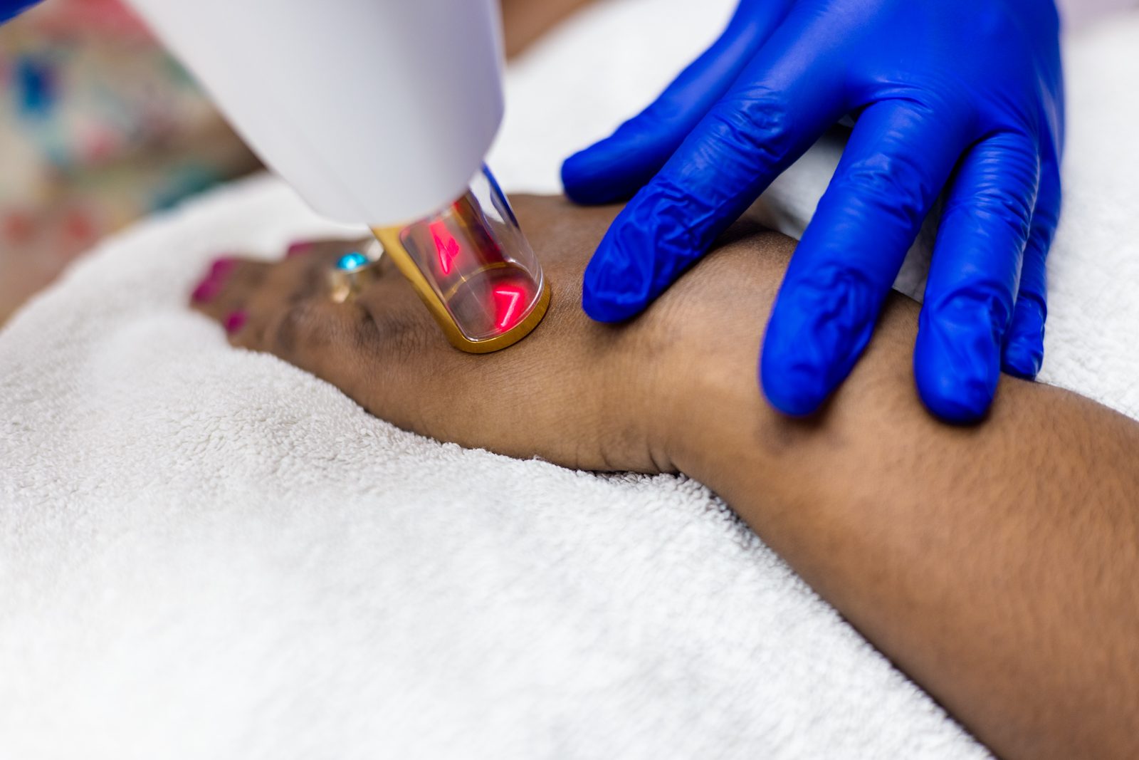 Body scar treatment setup at Armoraa skin clinic, Chennai