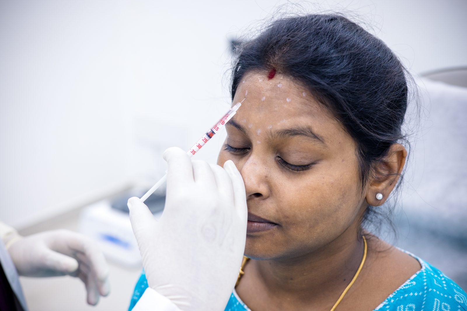 Botox injection technique at Armoraa skin clinic, Chennai
