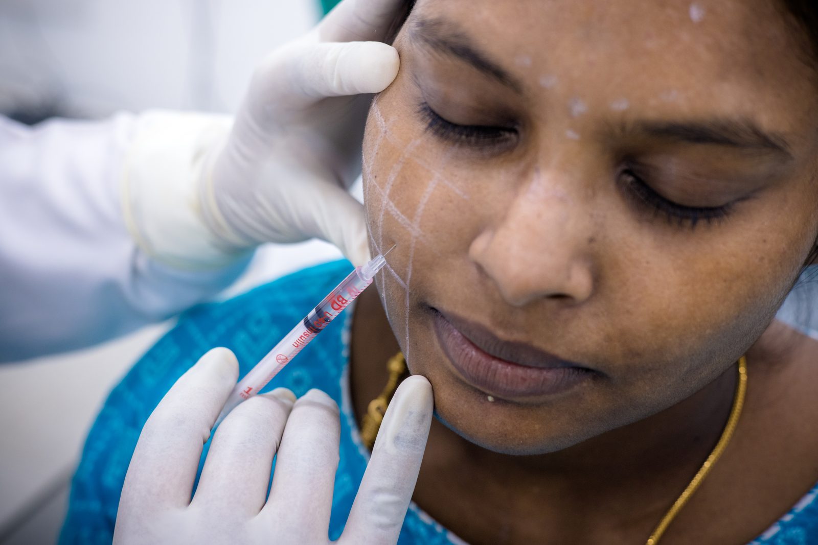 Botox treatment procedure at Armoraa skin clinic, Chennai