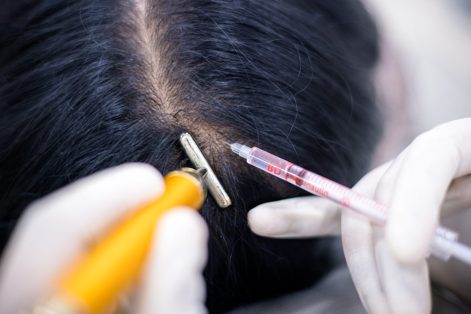 Scalp injectable treatment procedure at Armoraa skin clinic, Chennai