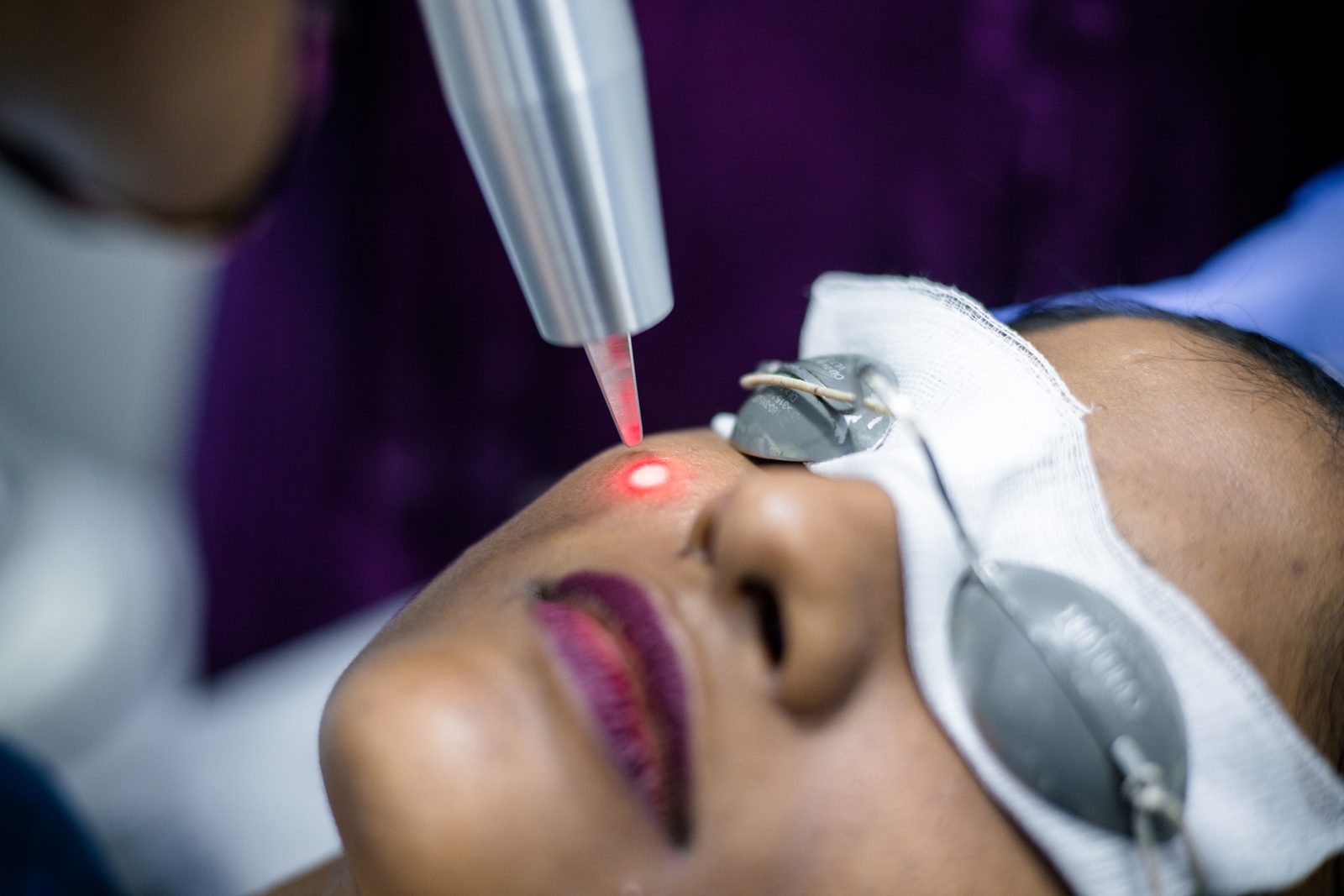Pigmentation laser treatment procedure at Armoraa skin clinic, Chennai
