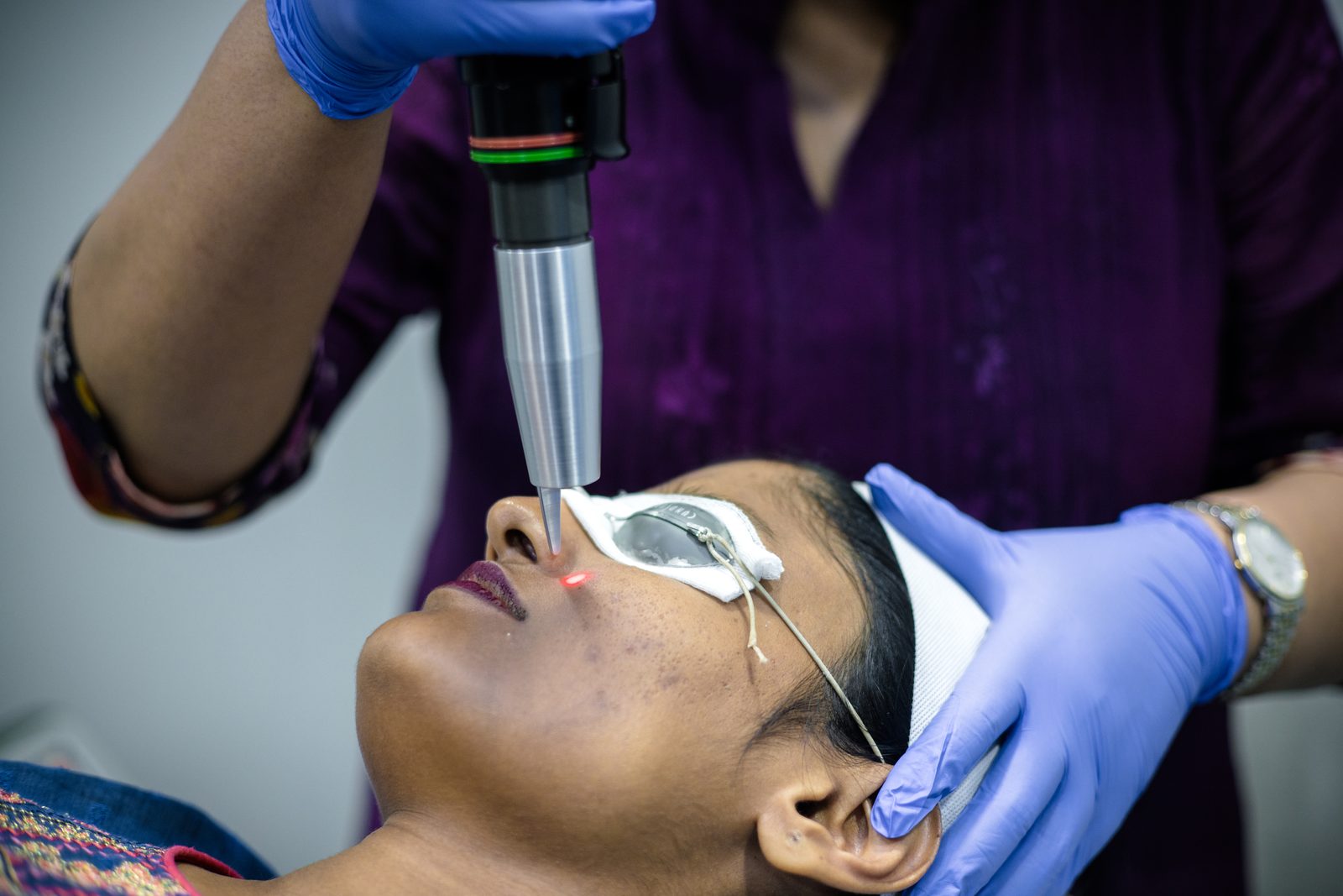 Pigment laser treatment session at Armoraa skin clinic, Chennai