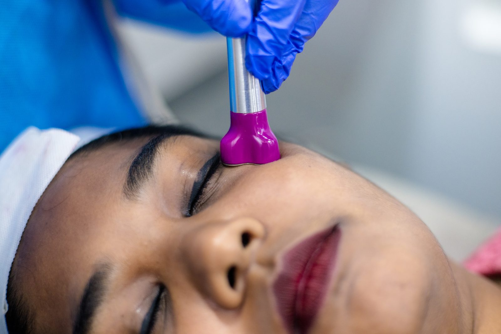 Radiofrequency skin tightening treatment at Armoraa skin clinic, Chennai