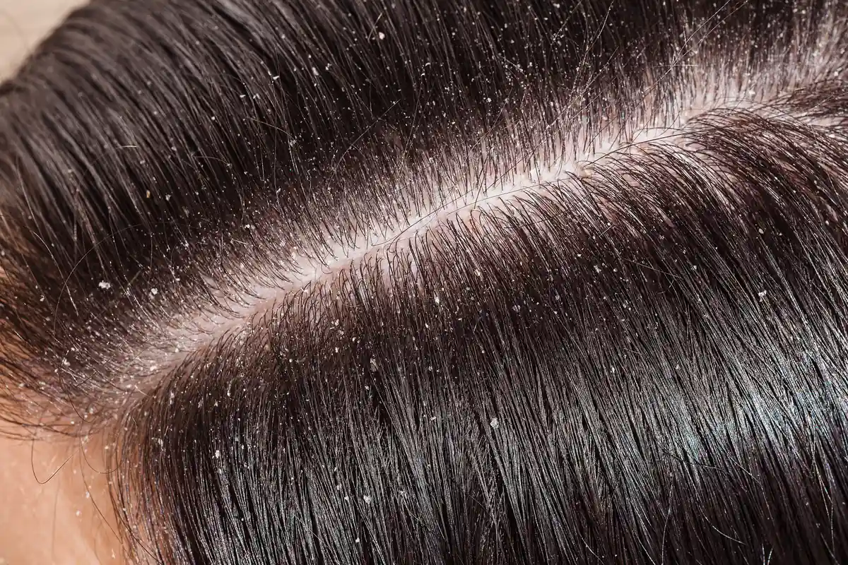 Close-up of an oily scalp with dandruff flakes